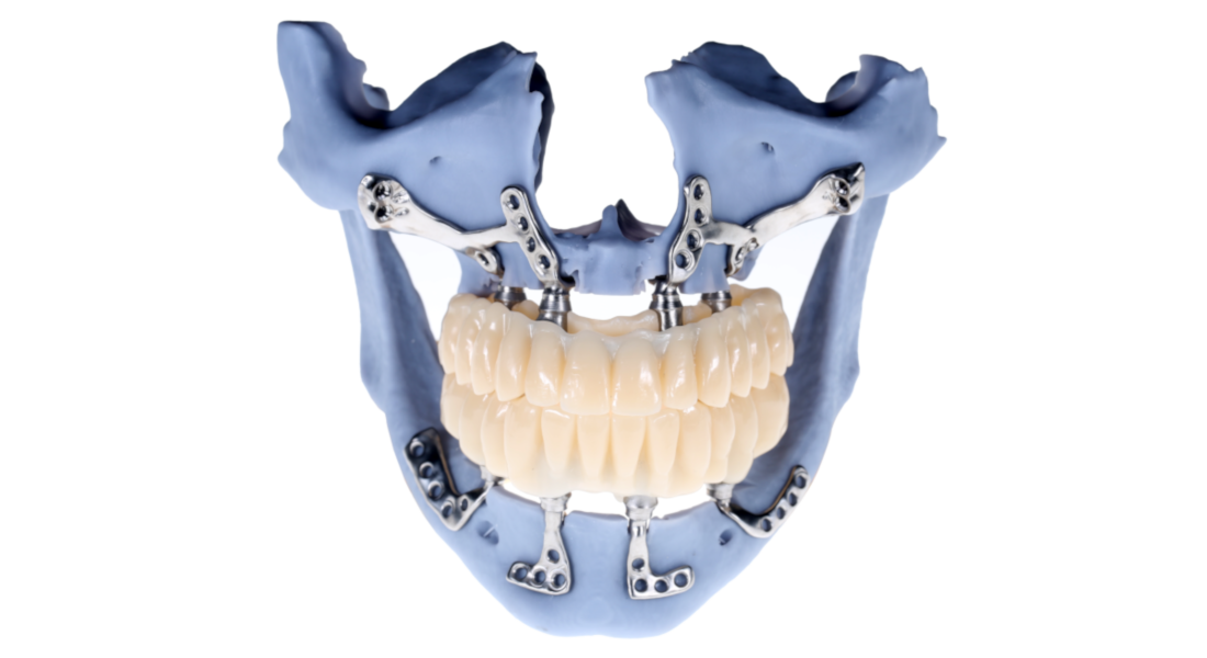 Individual Implant Planning