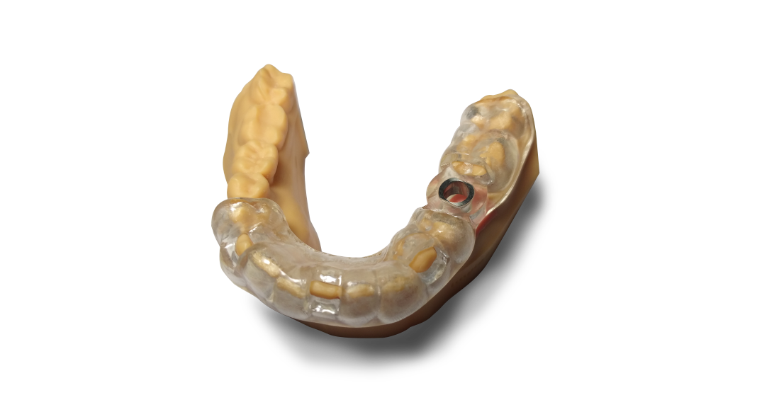 Tooth-Supported Surgical Guide