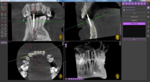 Checking the implant position