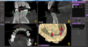 Implant position made in ImplaStationn planning in ImplaStation