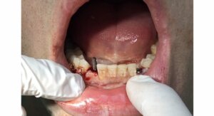 CowellMedi Implant installed