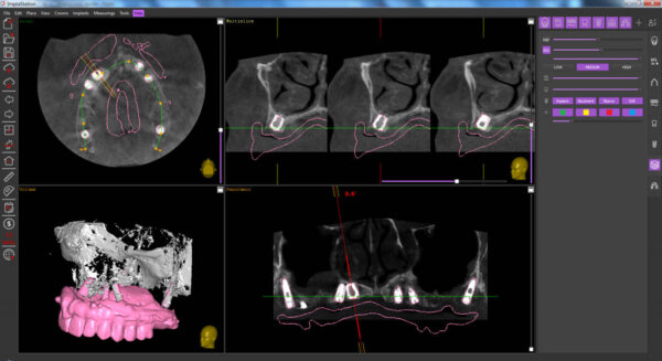 control ct after the procedure in ImplaStation