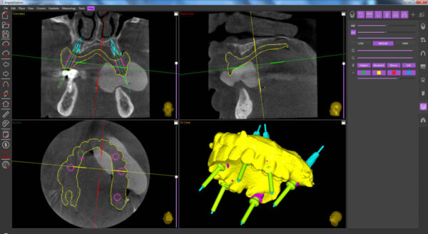 CT scan with a prosthesis in the patient’s mouth in ImplaStation