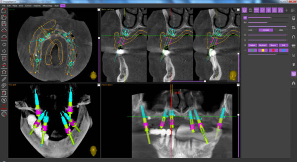 dental implant planning in ImplaStation