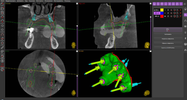 full edentulous jaw - dental implant plan