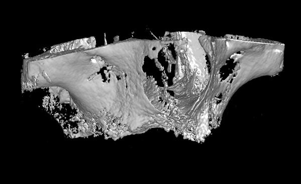 full maxilla edentulous CBCT