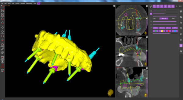 prosthetic driven implantation in ImplaStation