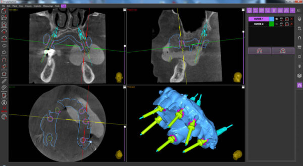 surgical guide based on the prosthesis scan in ImplaStation