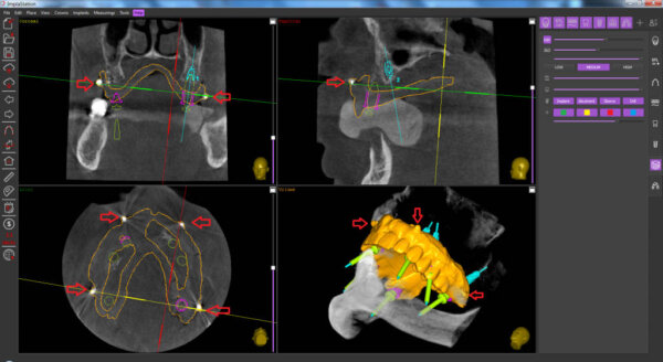 The alignment by X-ray contrast marks