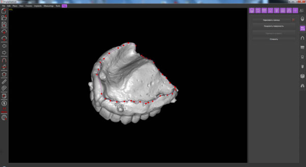 the prosthesis scan in ImplaStation