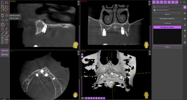 control ct after the procedure