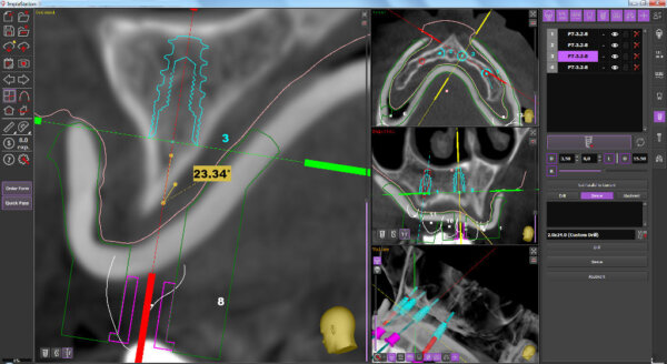 implant position in Implastation