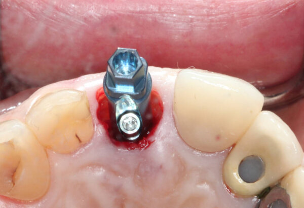 Southern Implants Co-Axis INVERTA fixture placed