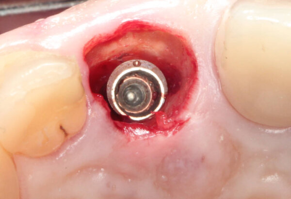 Southern Implants Co-Axis INVERTA fixture placed 2