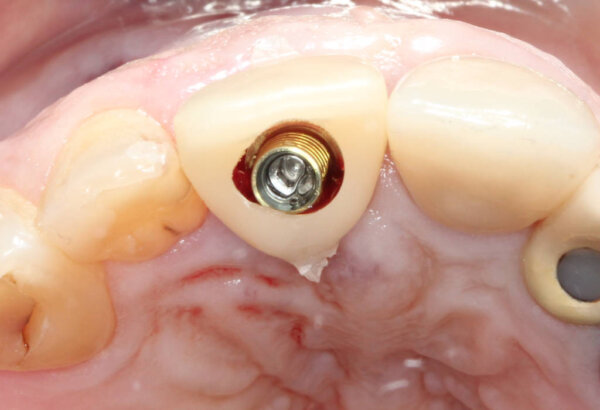 Temporary pre milled CadCam crown in location