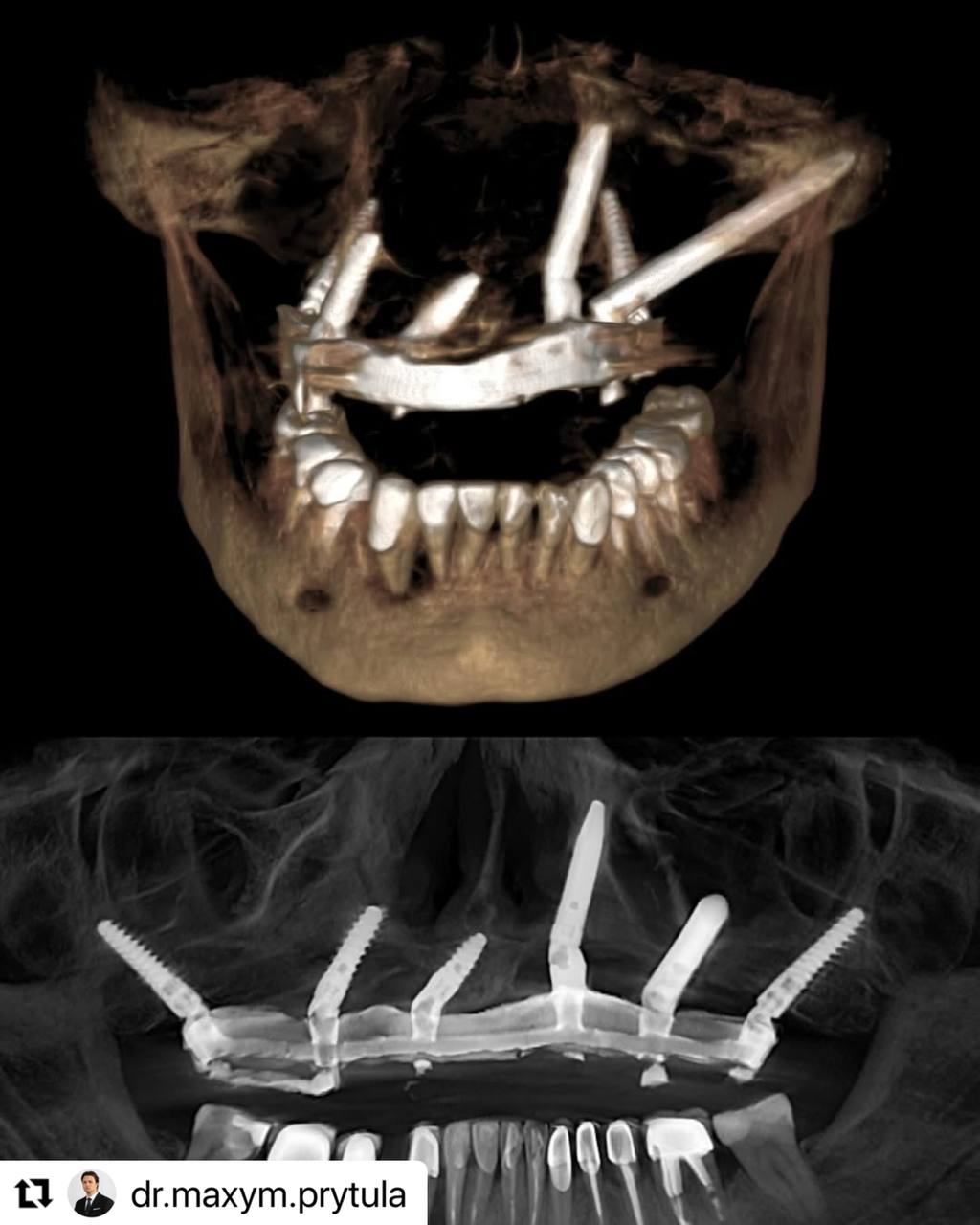 severe peri-implantitis_implastation