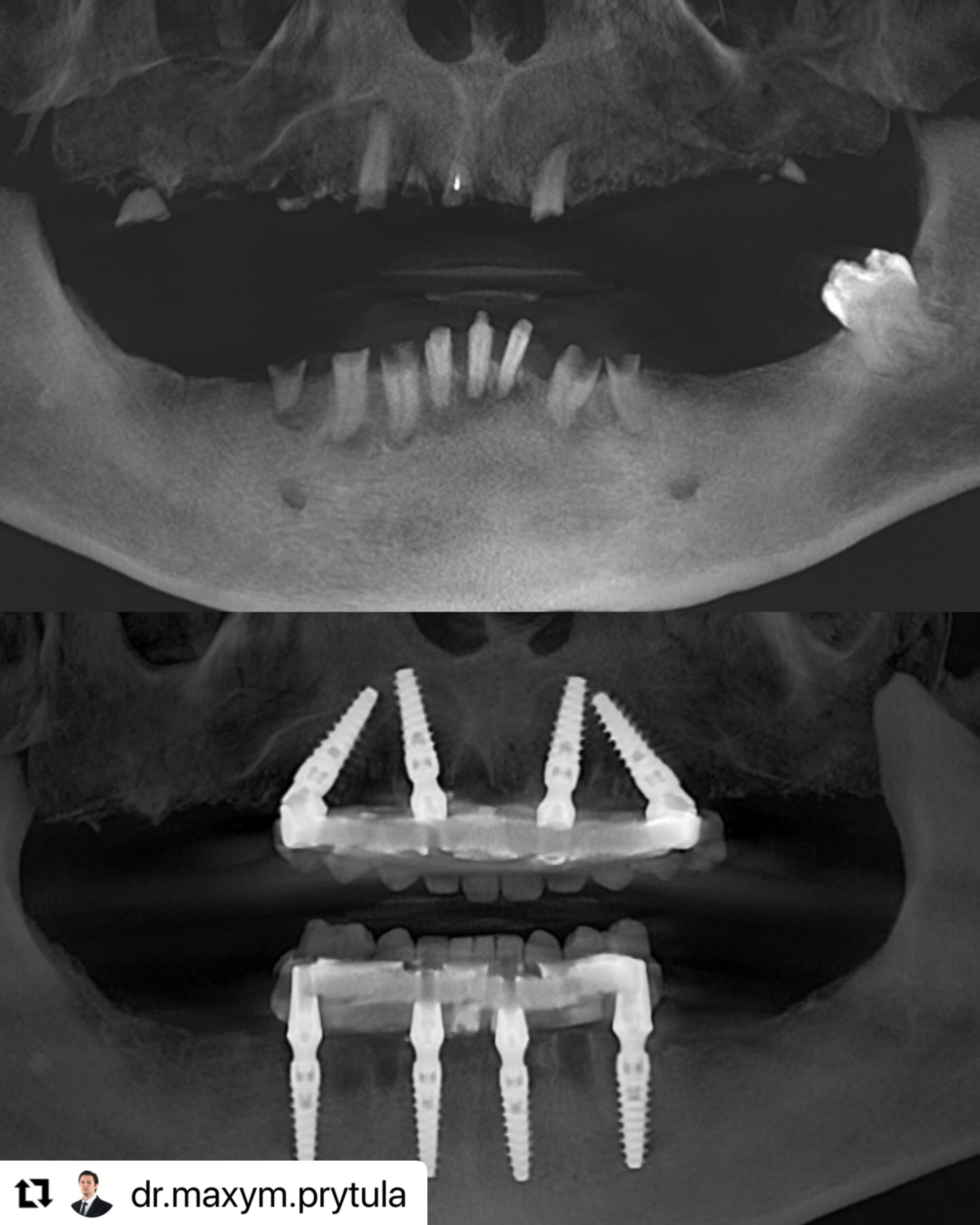 Full_arch_rehab_ImplaStation_Prytula