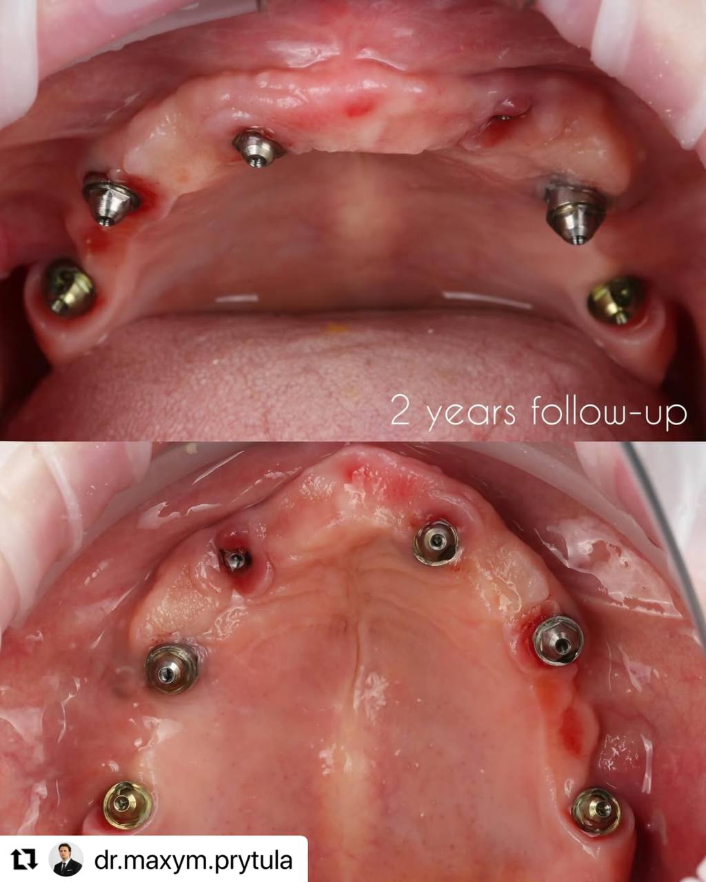 2_years_follow_up_case