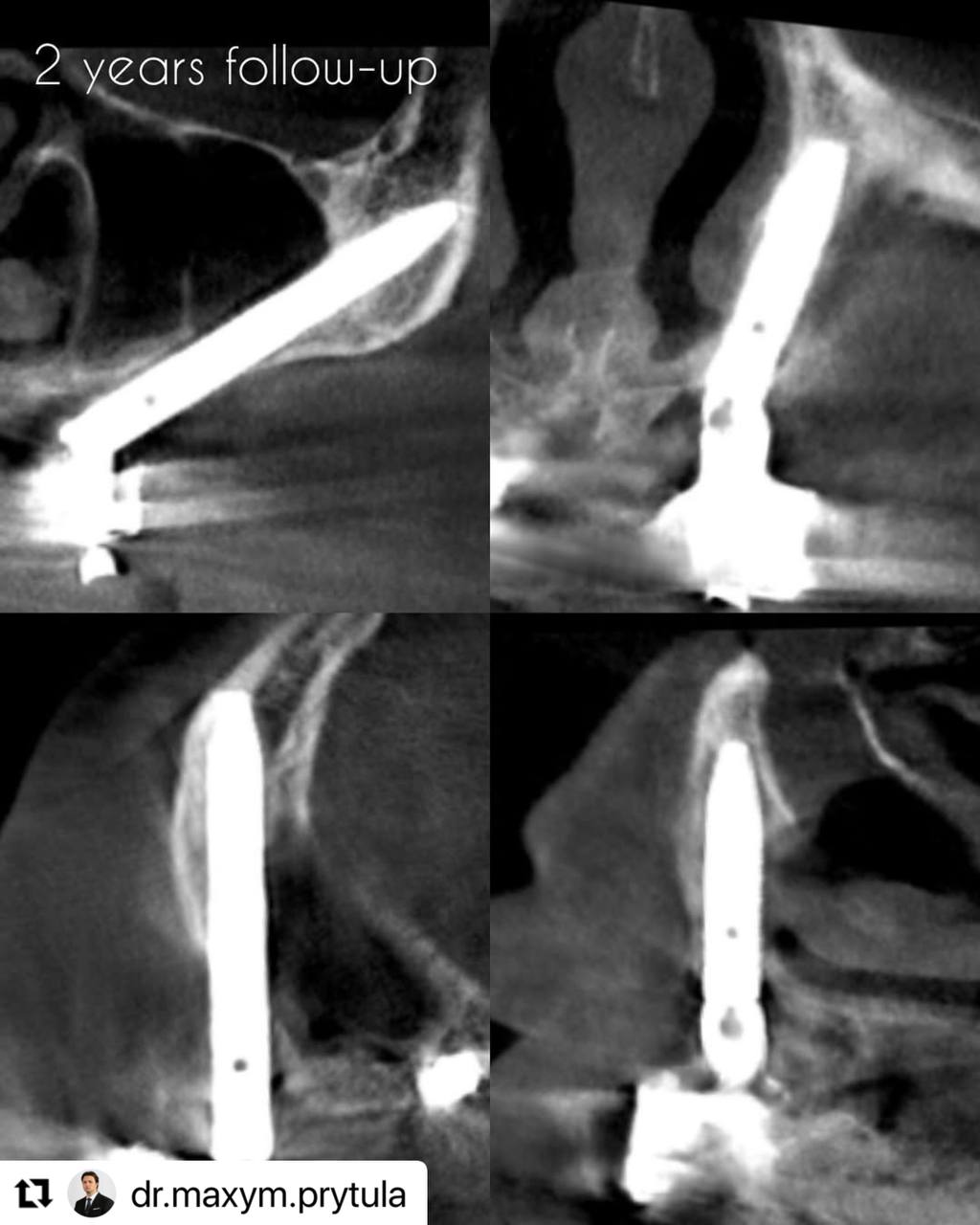 2_years_follow_up_case2