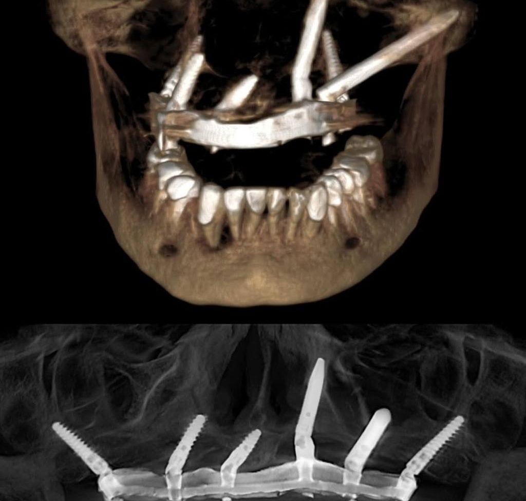 Hybrid Implant Strategy for Oro-Nasal Communication: 2-Year Follow-Up