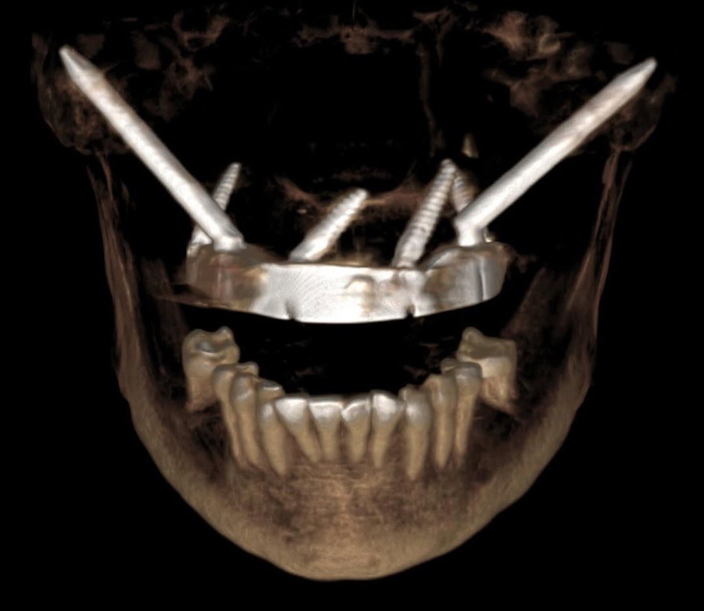 Full-Arch Re-Treatment: Applying Hybrid Implant Configurations for Optimal Outcomes