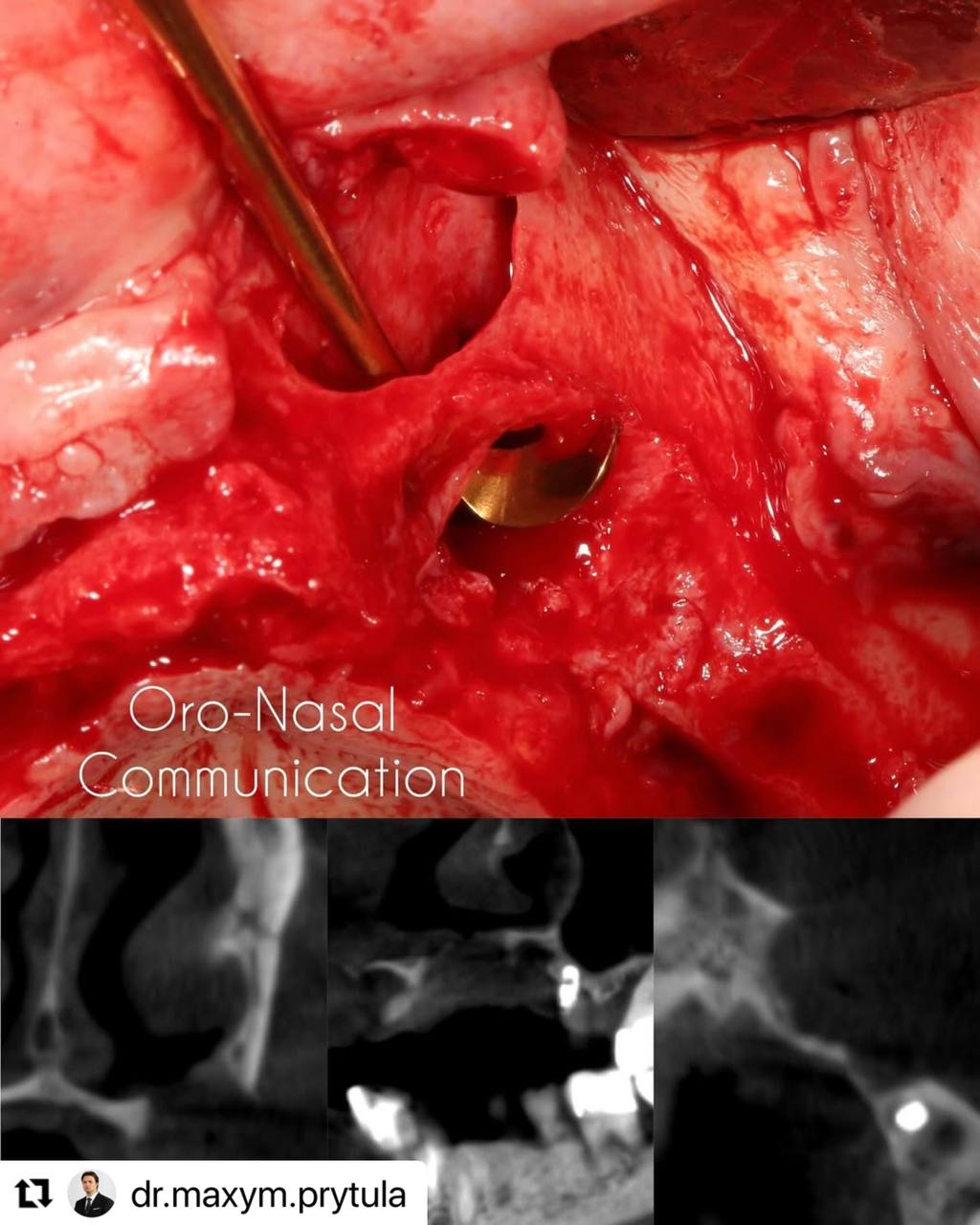 Oro-Nasal Communication _implastation