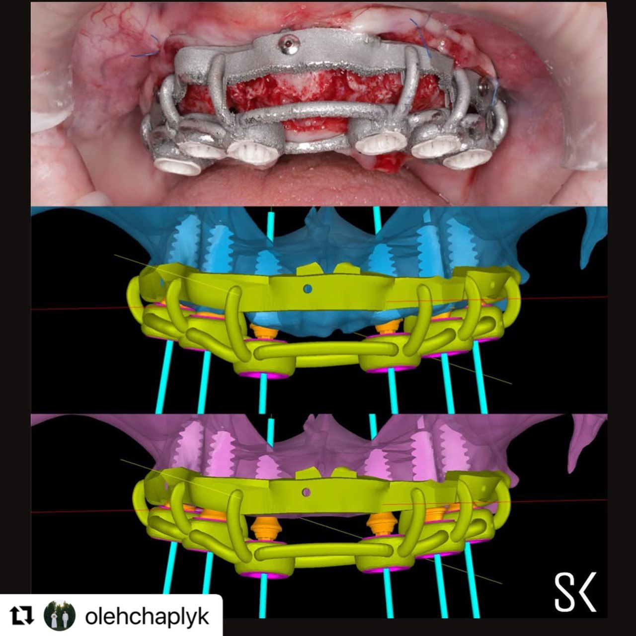 full_mouth_case_implastation_chaplyk