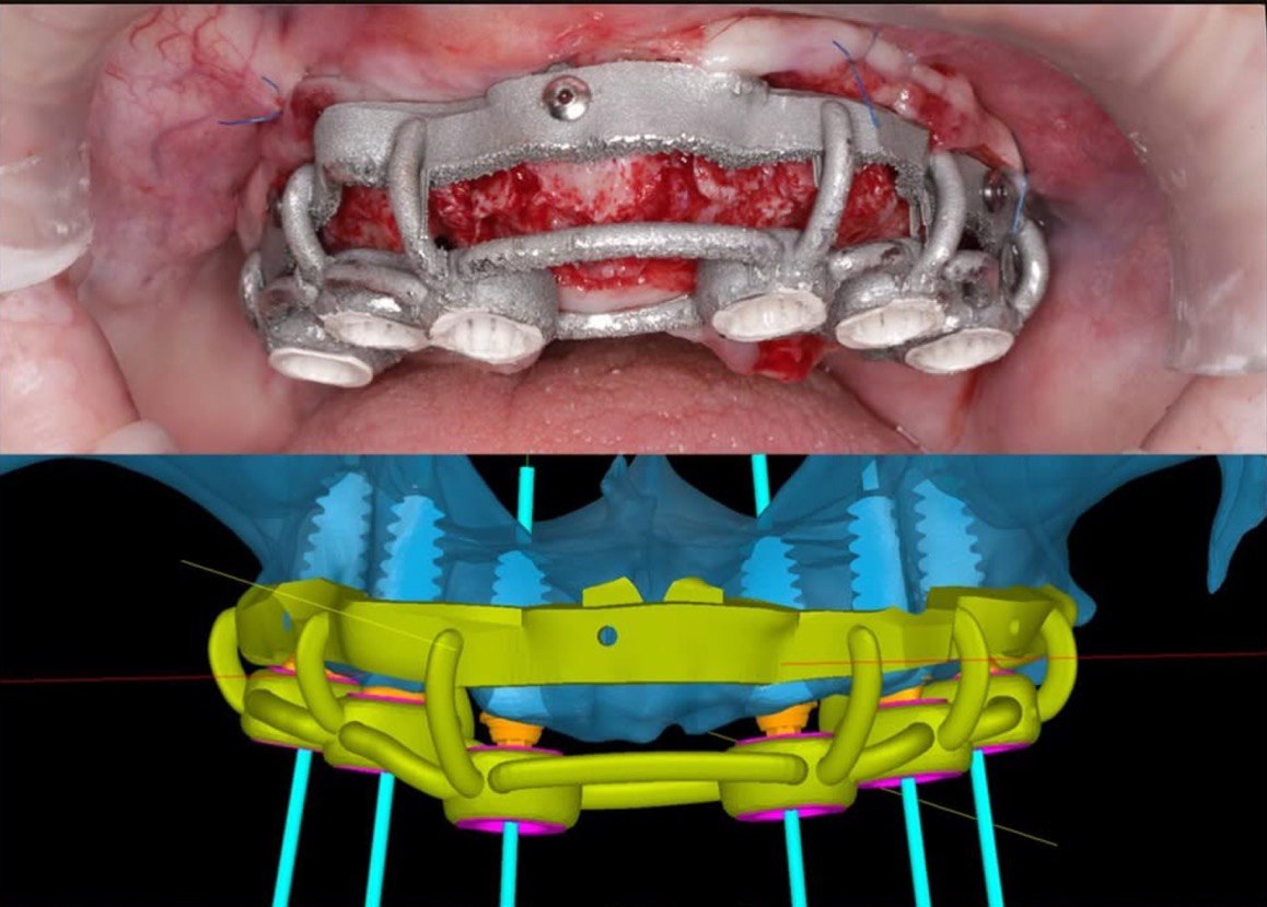 Full-Mouth Implant Placement with Digital Planning: A Clinical Case Study