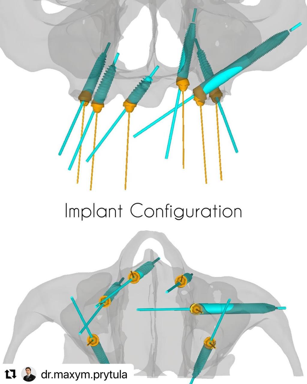 implant_configuration_case_ImplaStation