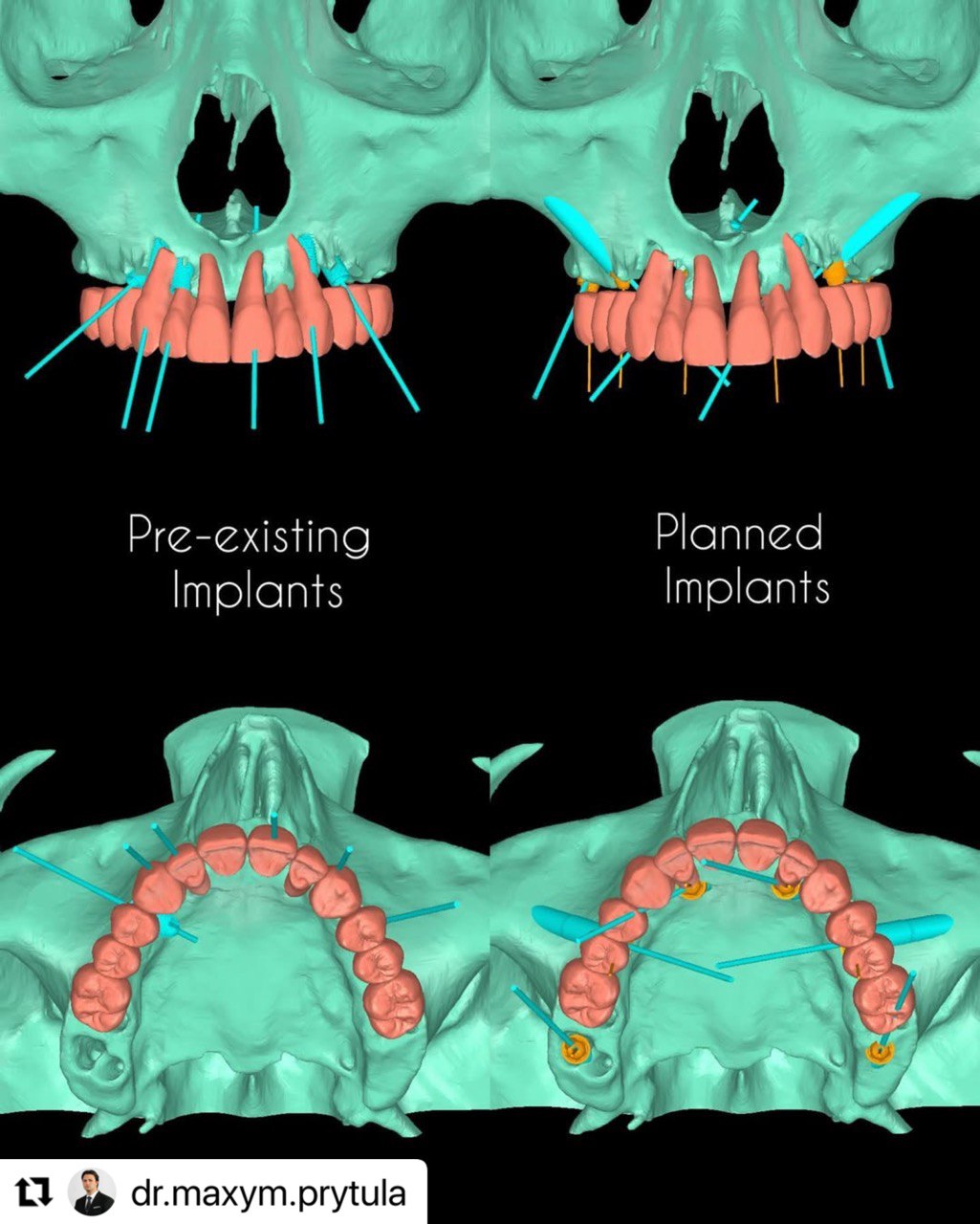 pre-existing_vs_planned_implants_ImplaStation