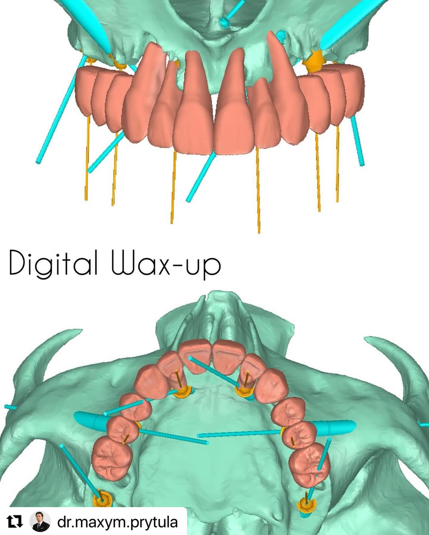 Digital_wax_up_ImplaStation