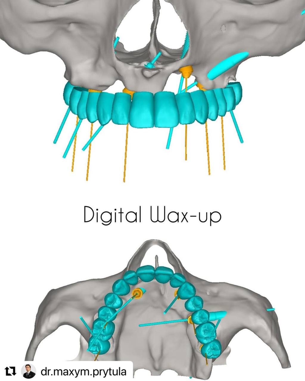 digital_wax_up_ImplaStation