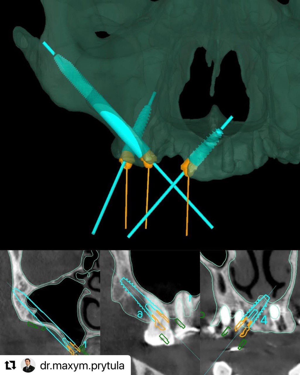 planned_implants_ImplaStation