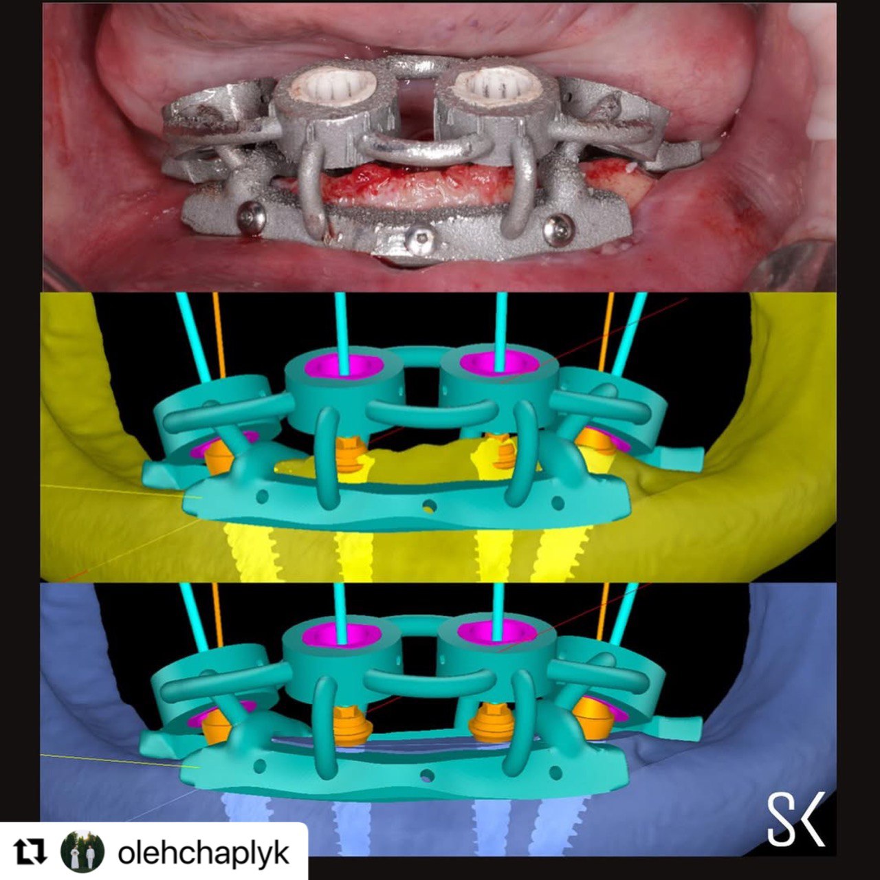 digital_screw_retained_implastation