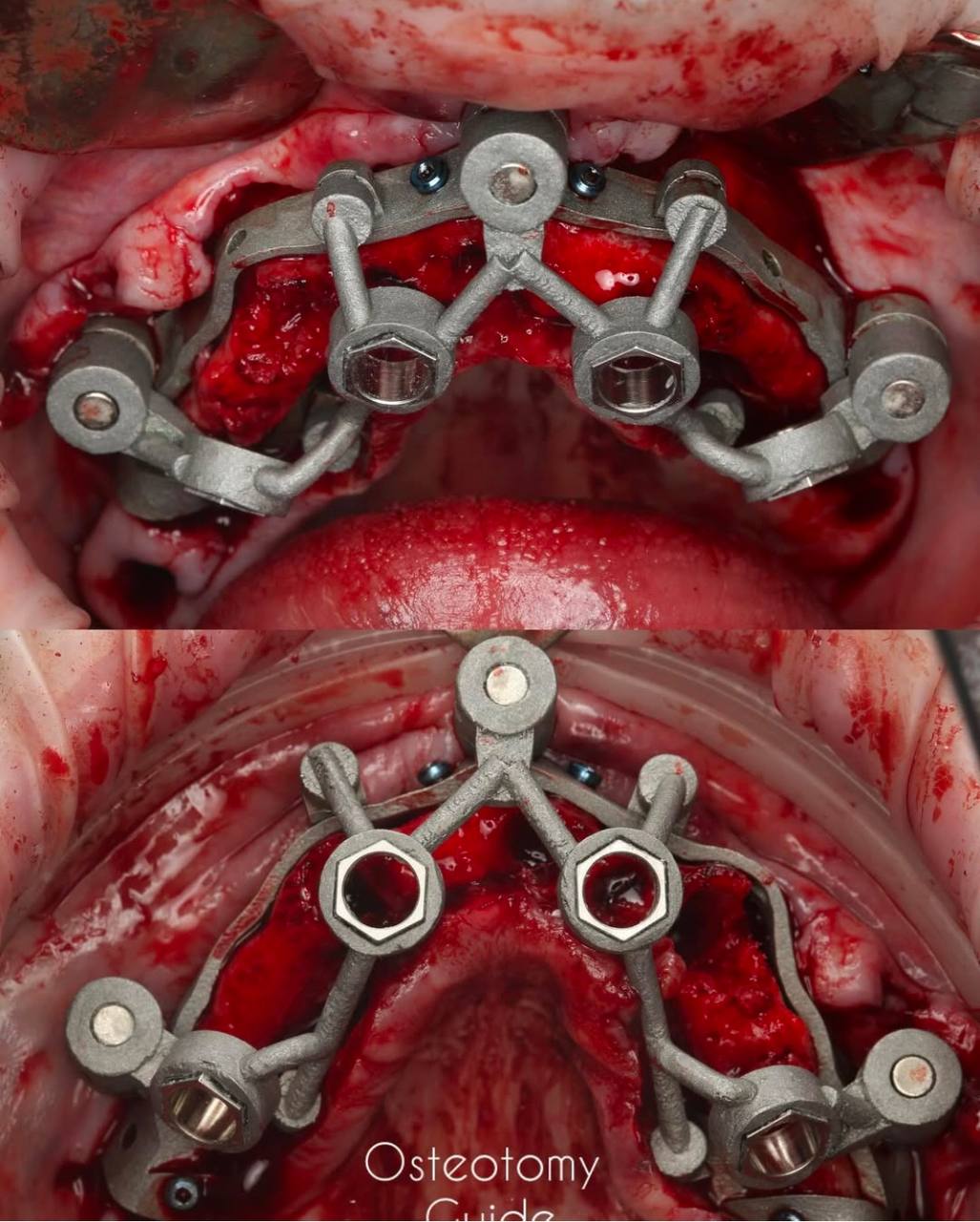 osteotomy_guide_prytula