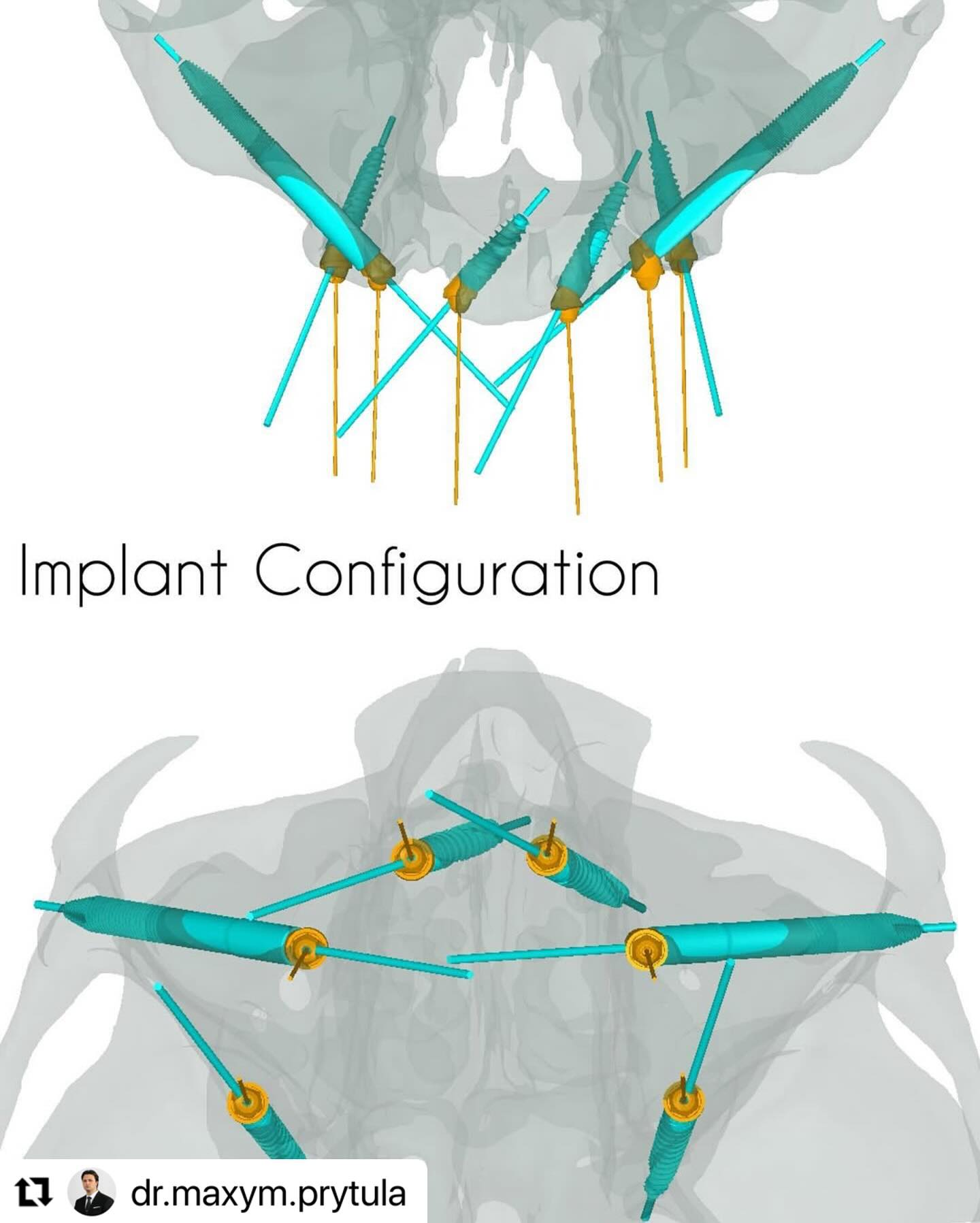 Implant_configuration_ImplaStation