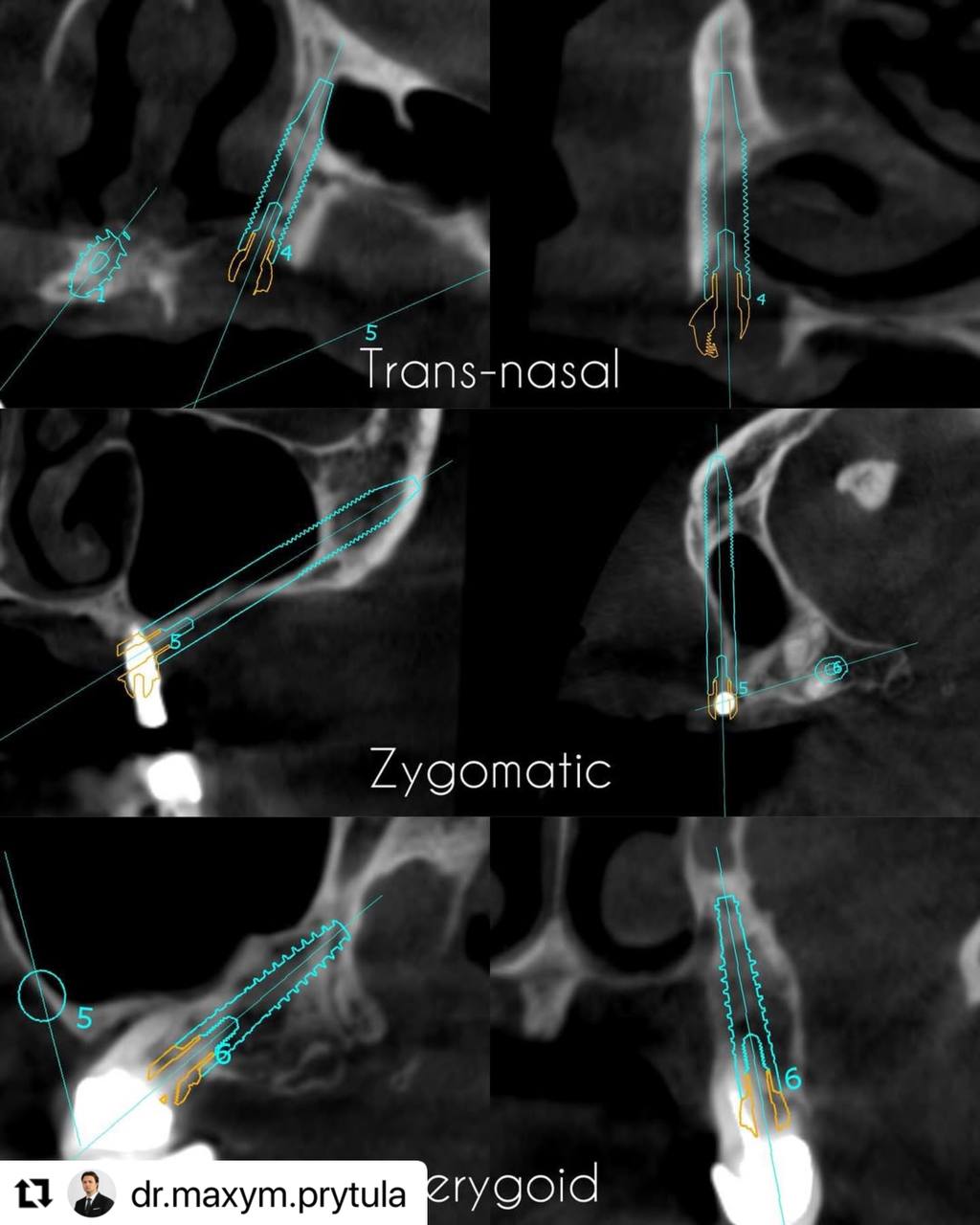 trans_nasal_zygomatic_pterygoid_implastation