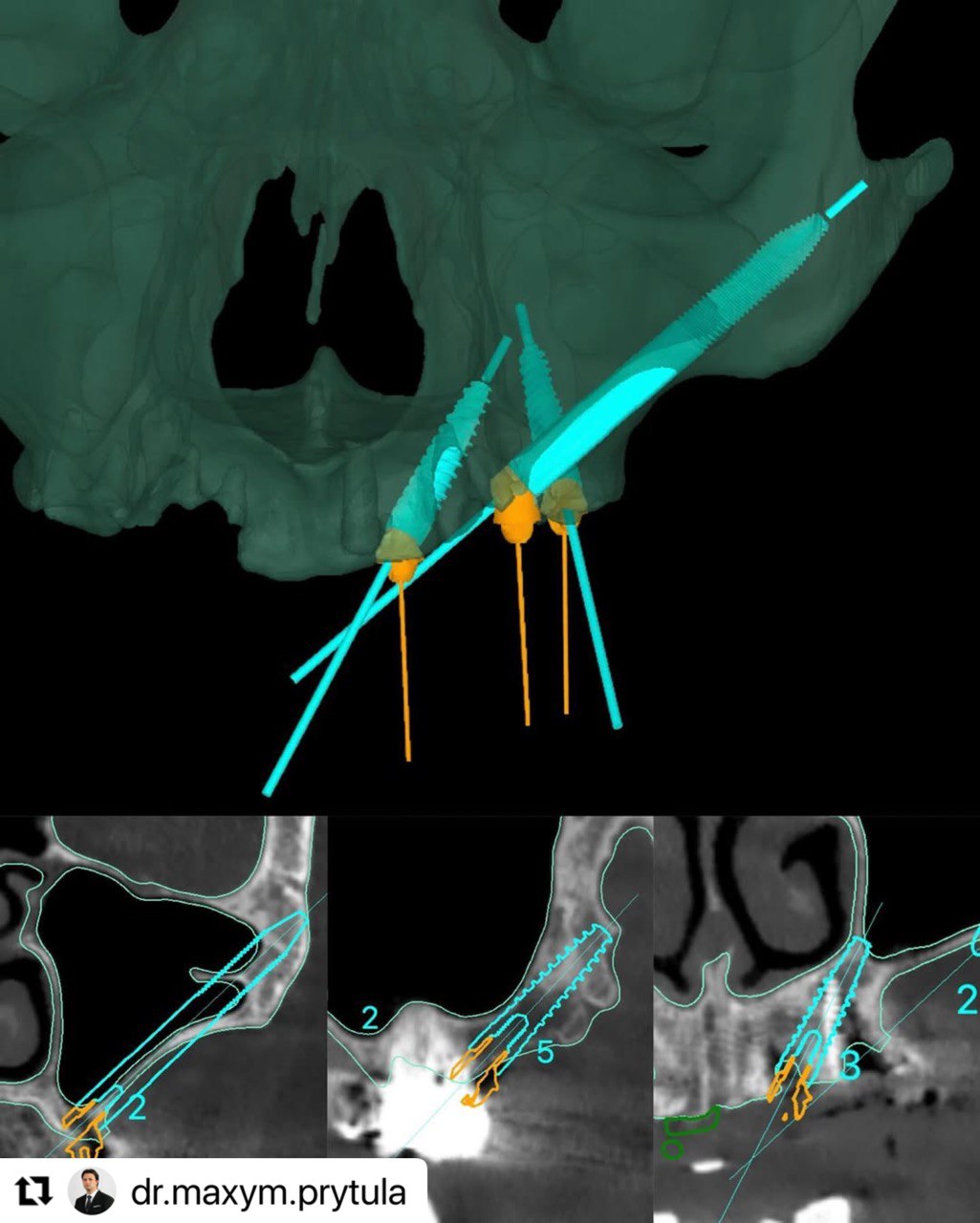 planned_implants_prytula_ImplaStation