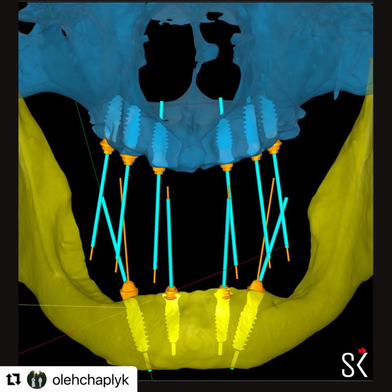 virtual_implant_placement_implastation