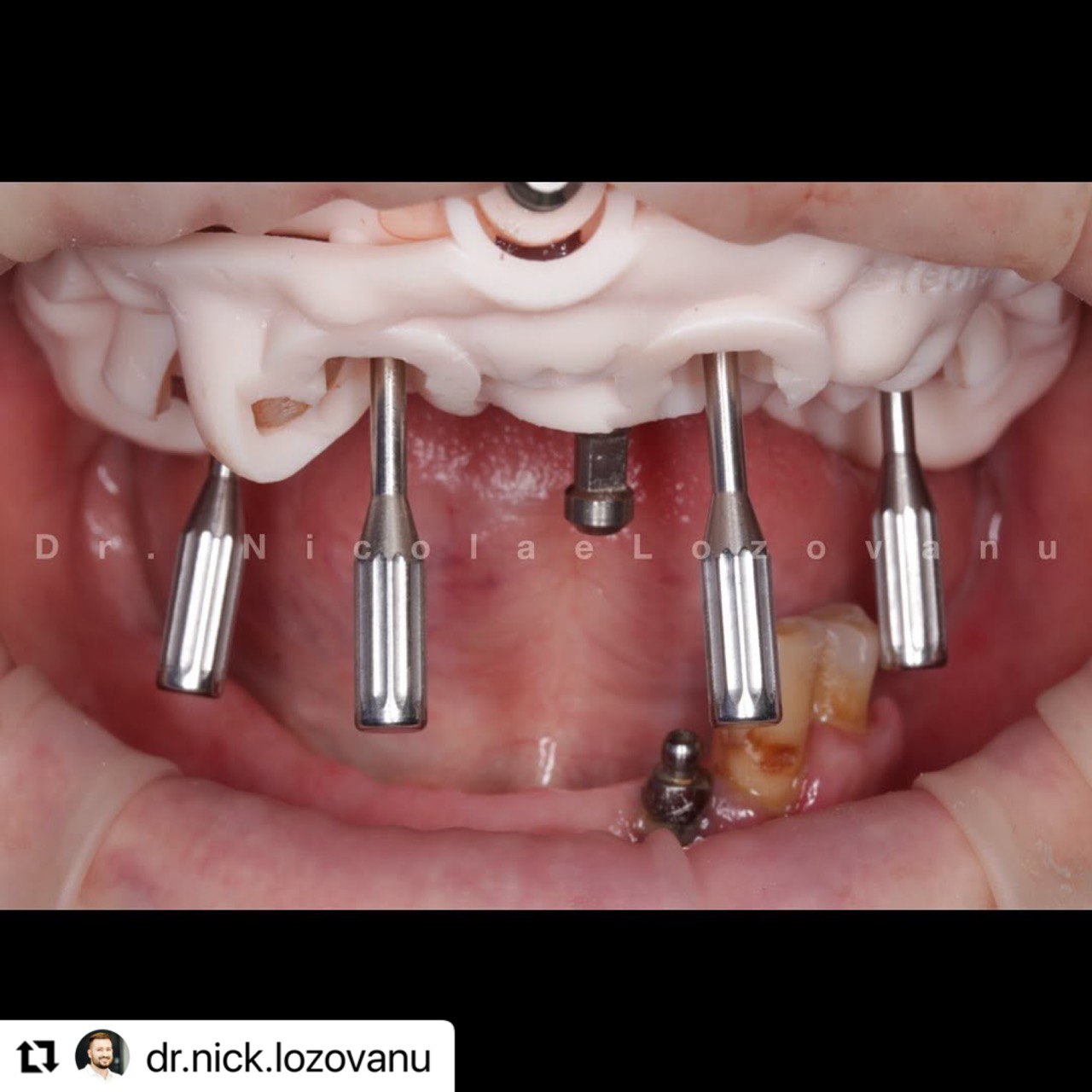 Stackable Guides in the mouth_ImplaStation_Lozovanu