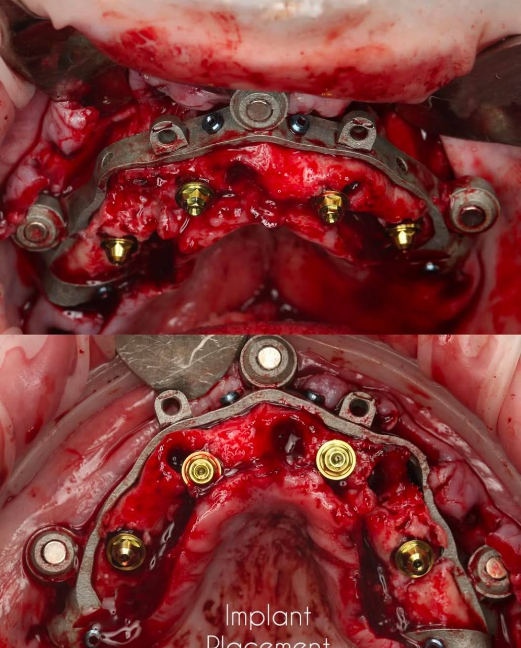 implant_placement_prytula