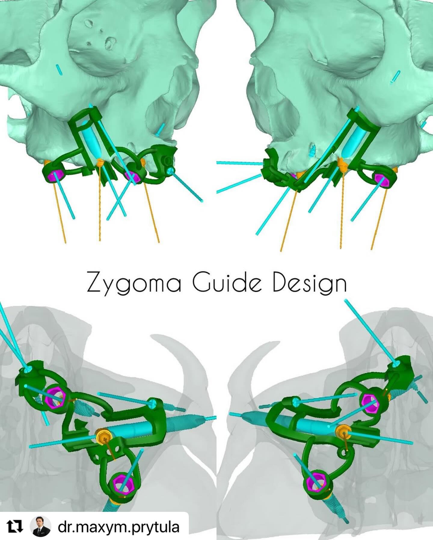 Zygoma_guide-design_ImplaStation