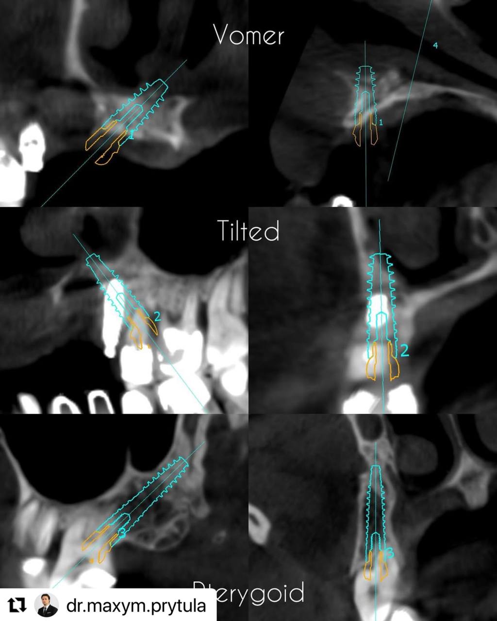 vomer_tilted_pterygoid_implastation