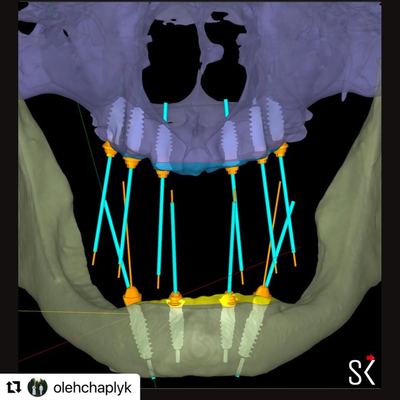 virtual_placement_of the implants_implastation