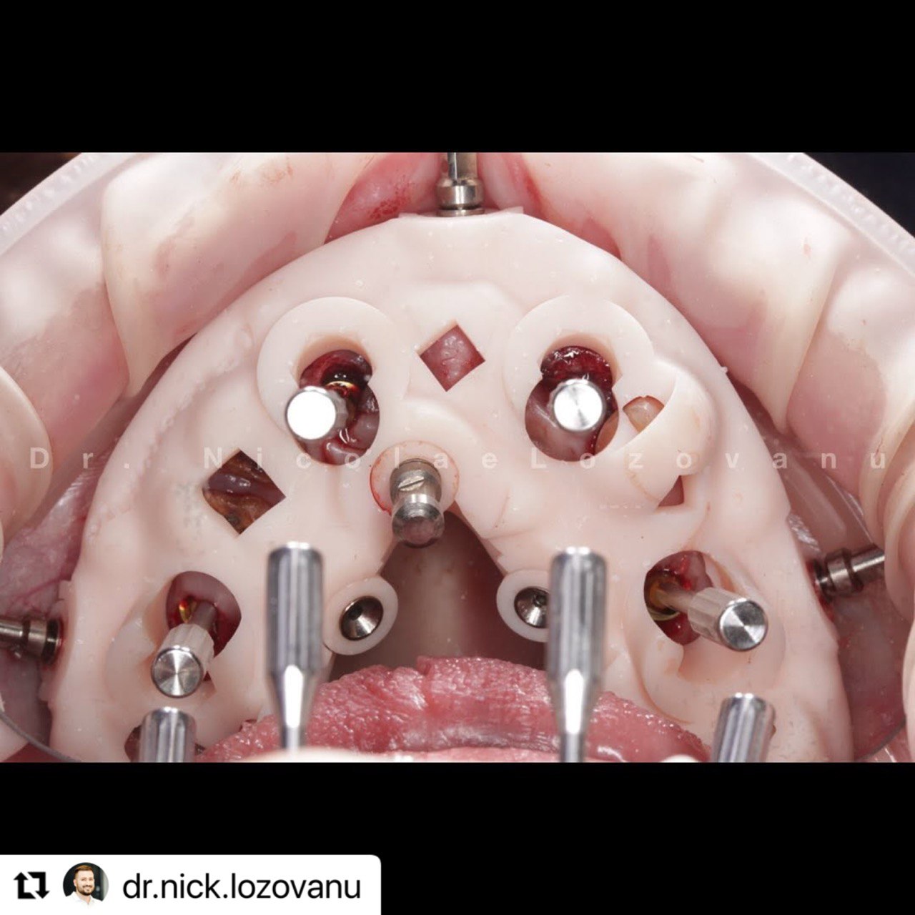 Guides Stackable in the mouth_ImplaStation_Lozovanu