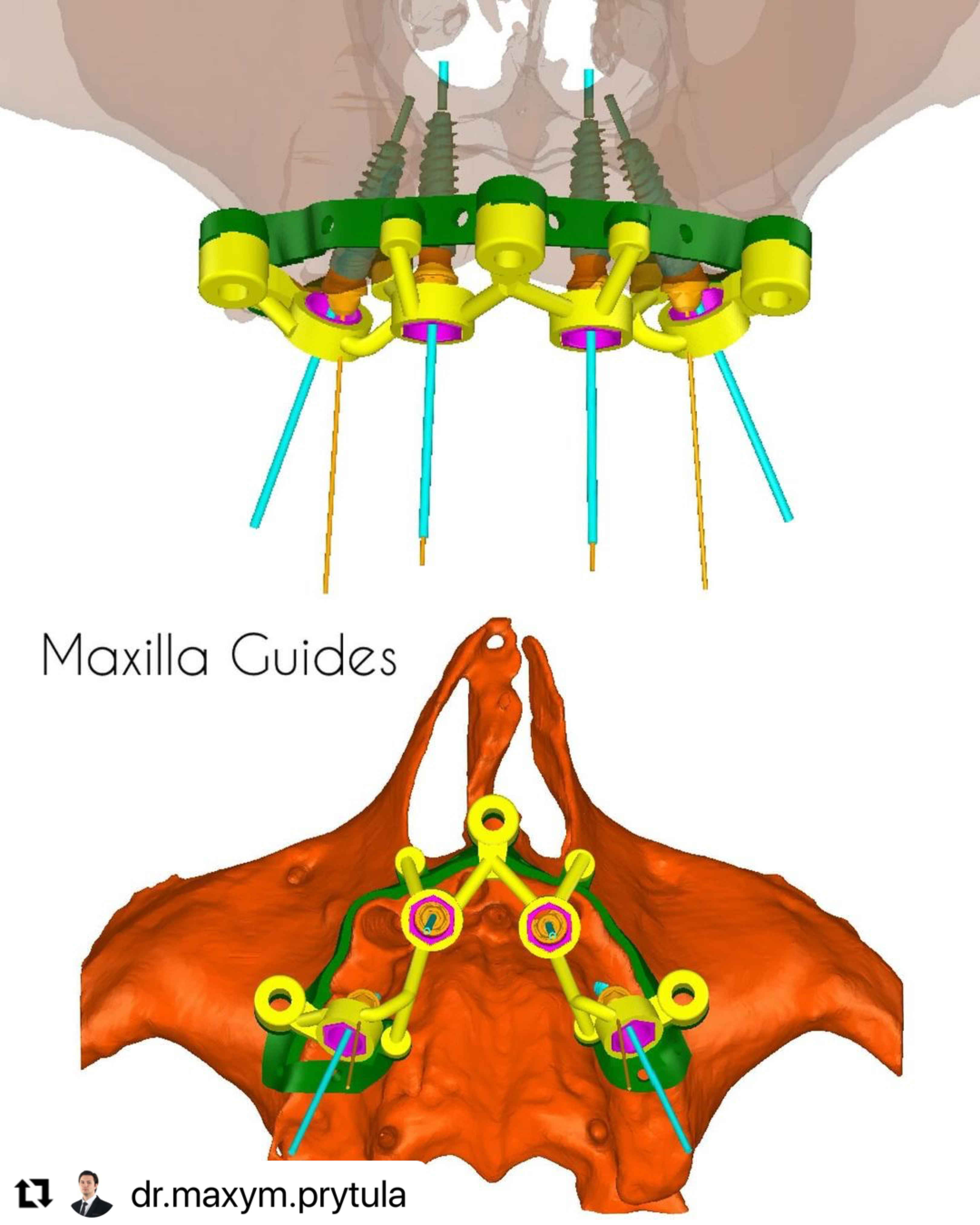 Maxilla_guide_ImplaStation