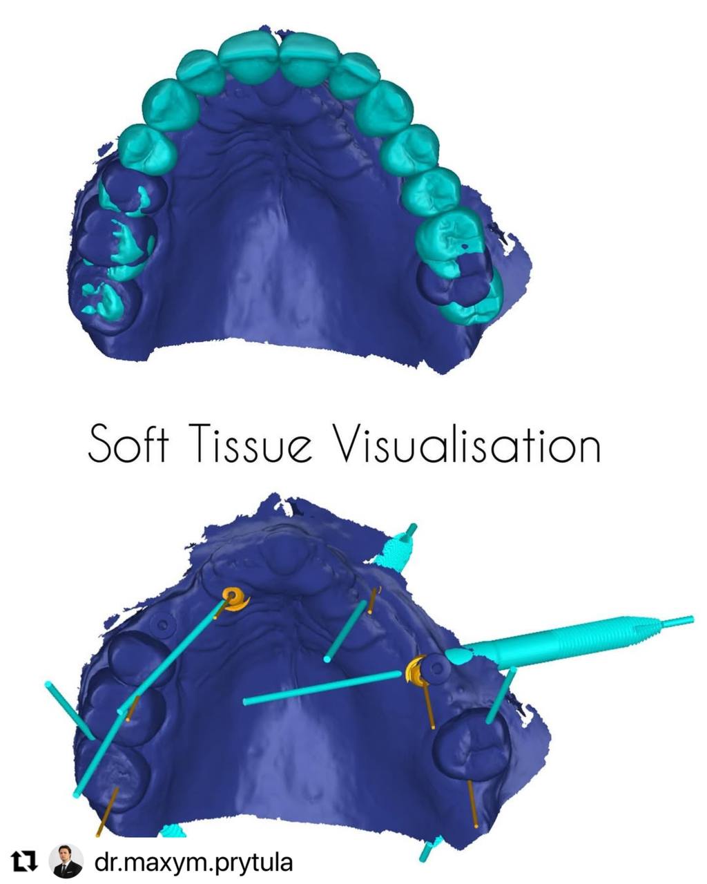 soft_tissue_vizual_implastation