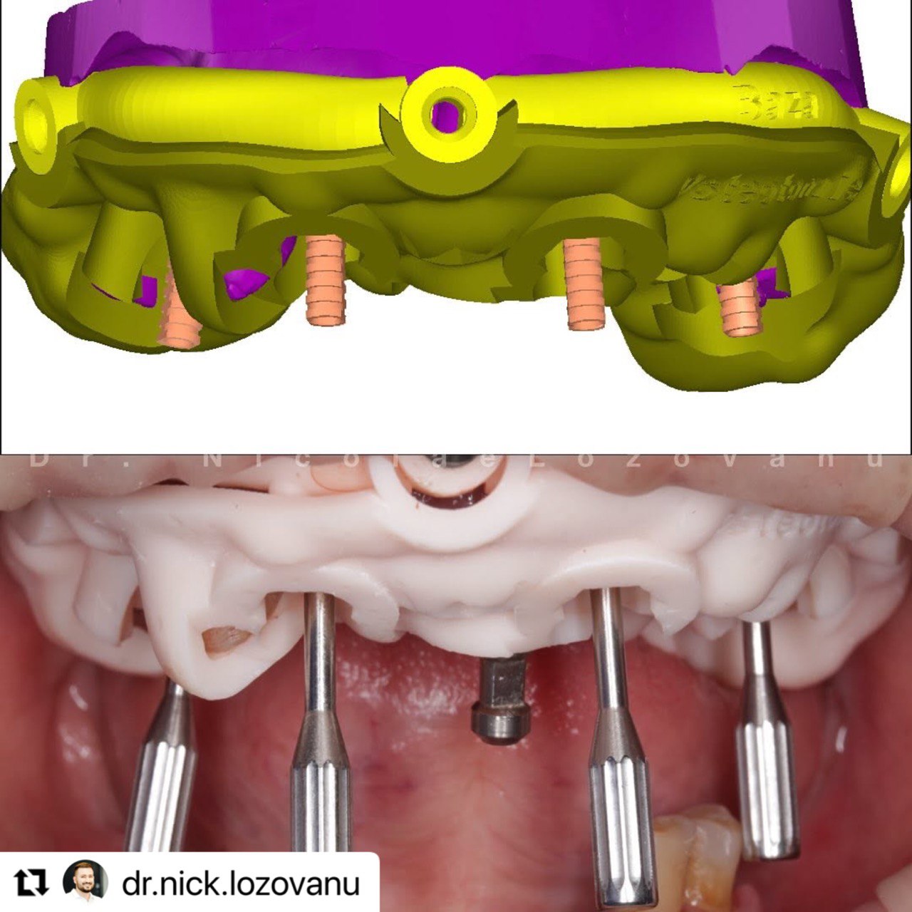 Revolutionizing All-on-4 Surgery with Stackable Guides and Flapless Techniques