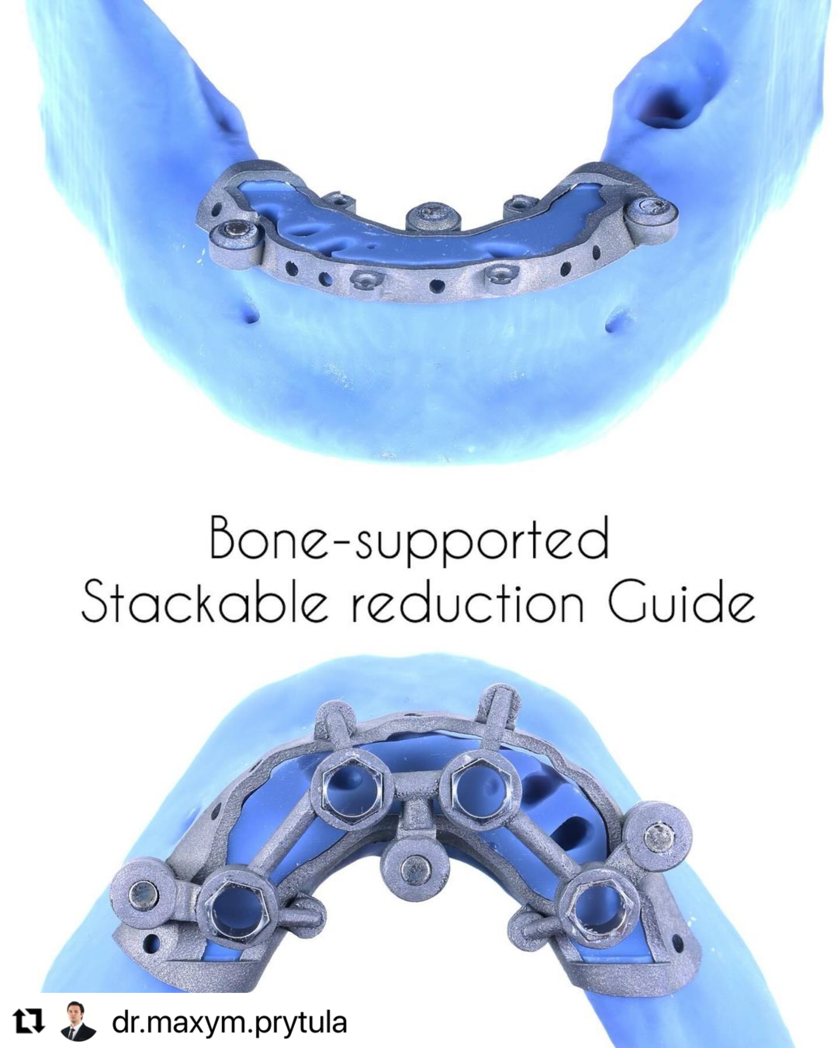 Bone_supported_stackable_reduction_guide_ImplaStation