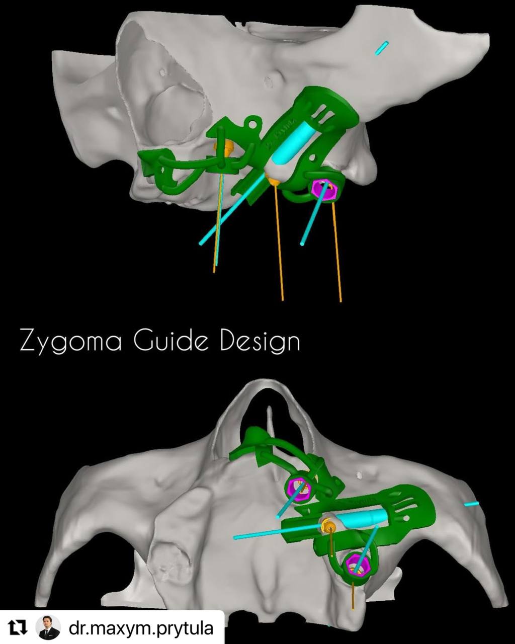 zygoma_guide_design_implastation